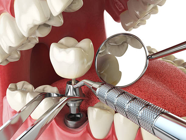 Best Emergency Root Canal Treatment in Mclean, TX