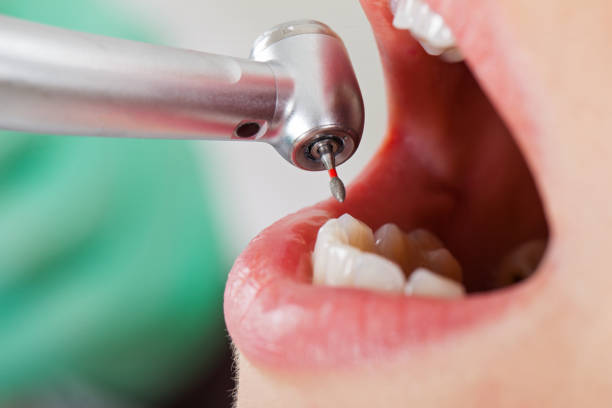 Best Emergency Dental Care for Broken or Chipped Teeth in Mclean, TX